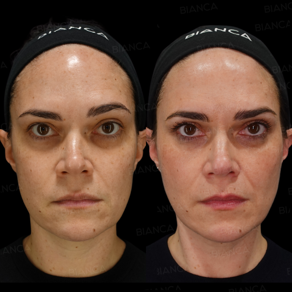 ヒアルロン酸注射(頬コケ+チークトップ)、BIANCA LIFT 6本、BIANCA LIFT W 2本、ベビーコラーゲン、ボトックス注射（眉上）