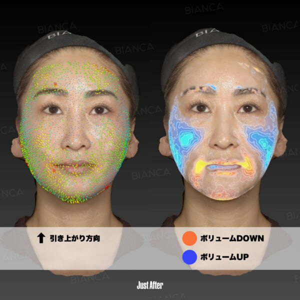 Alma Primex (顔)VISIA｜銀座・表参道にあるBIANCA CLINIC ビアンカクリニック｜美容外科・美容皮膚科・再生医療・美容婦人科・美容内科・医療アートメイク