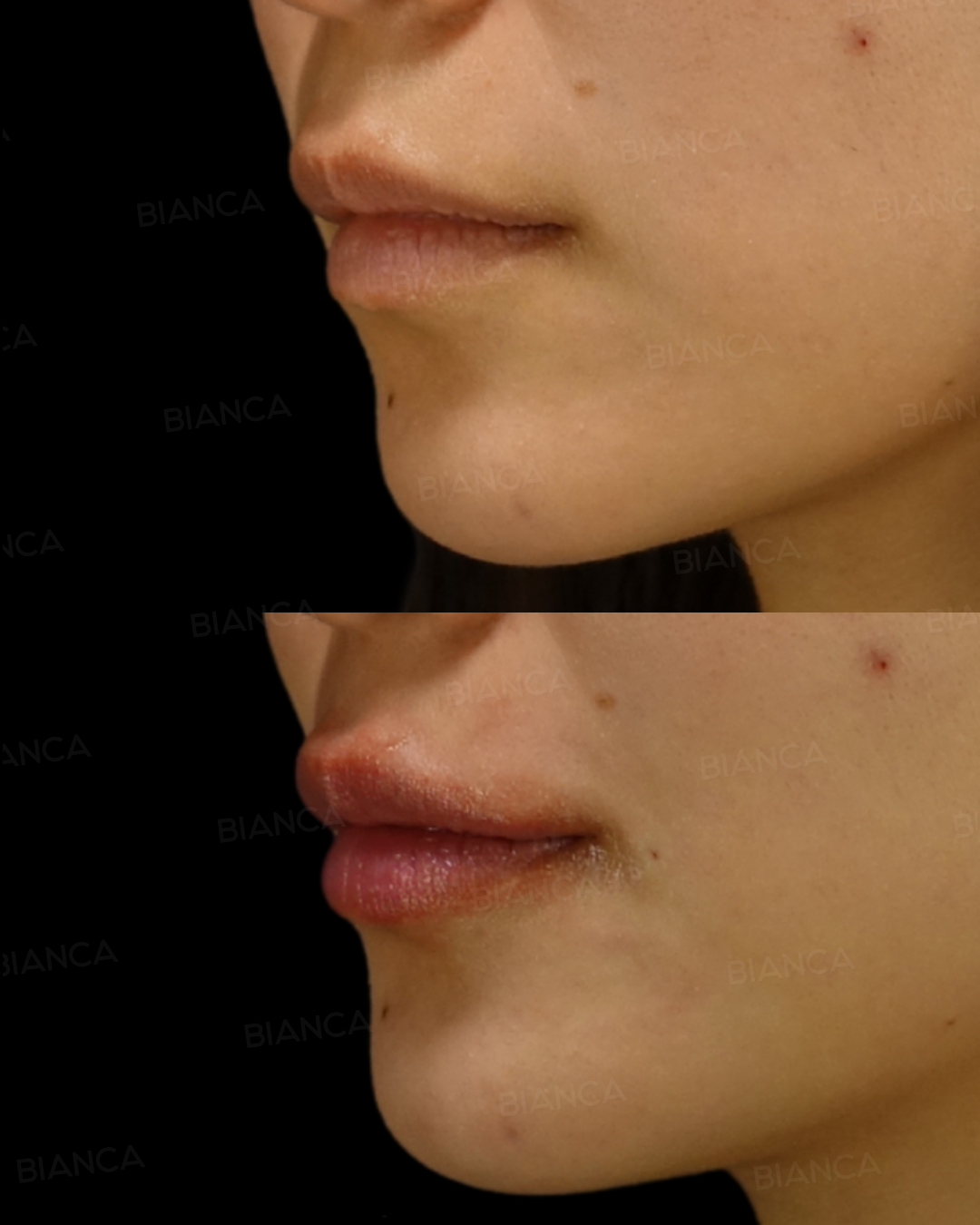 ヒアルロン酸注射(唇)