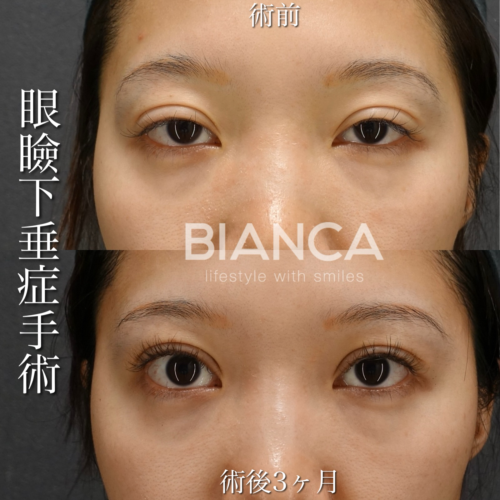 眼瞼下垂切開法