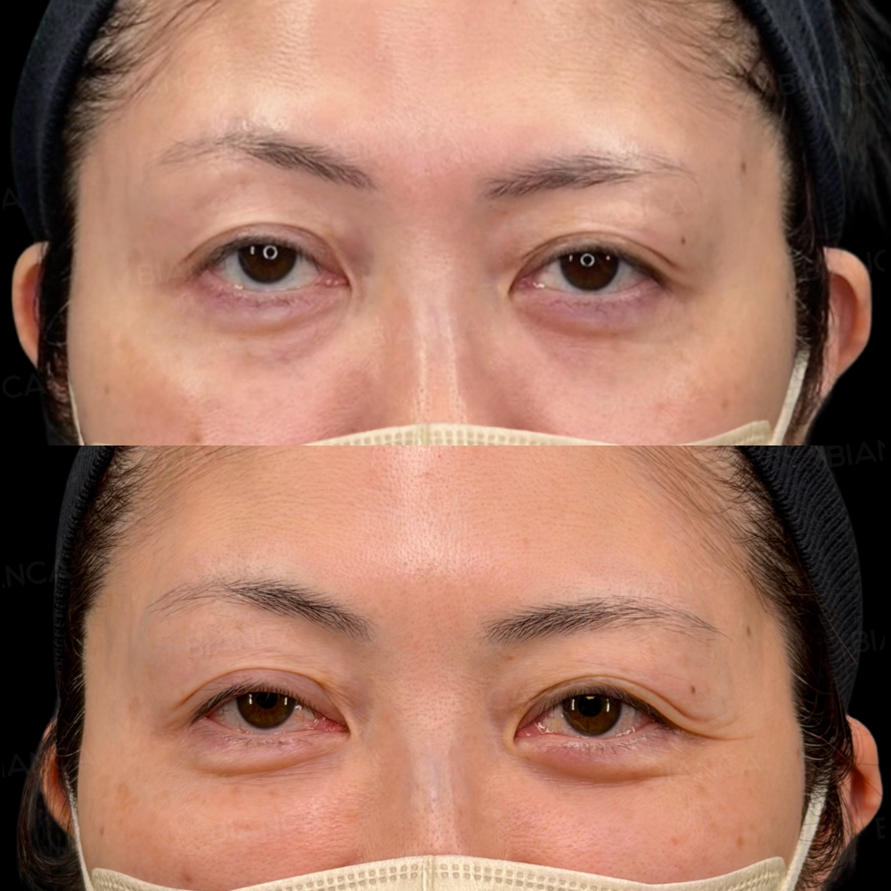 眼瞼下垂切開法、裏ハムラ法