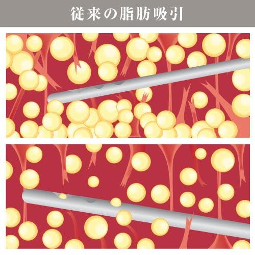 ベイザー脂肪吸引と従来の脂肪吸引の違い