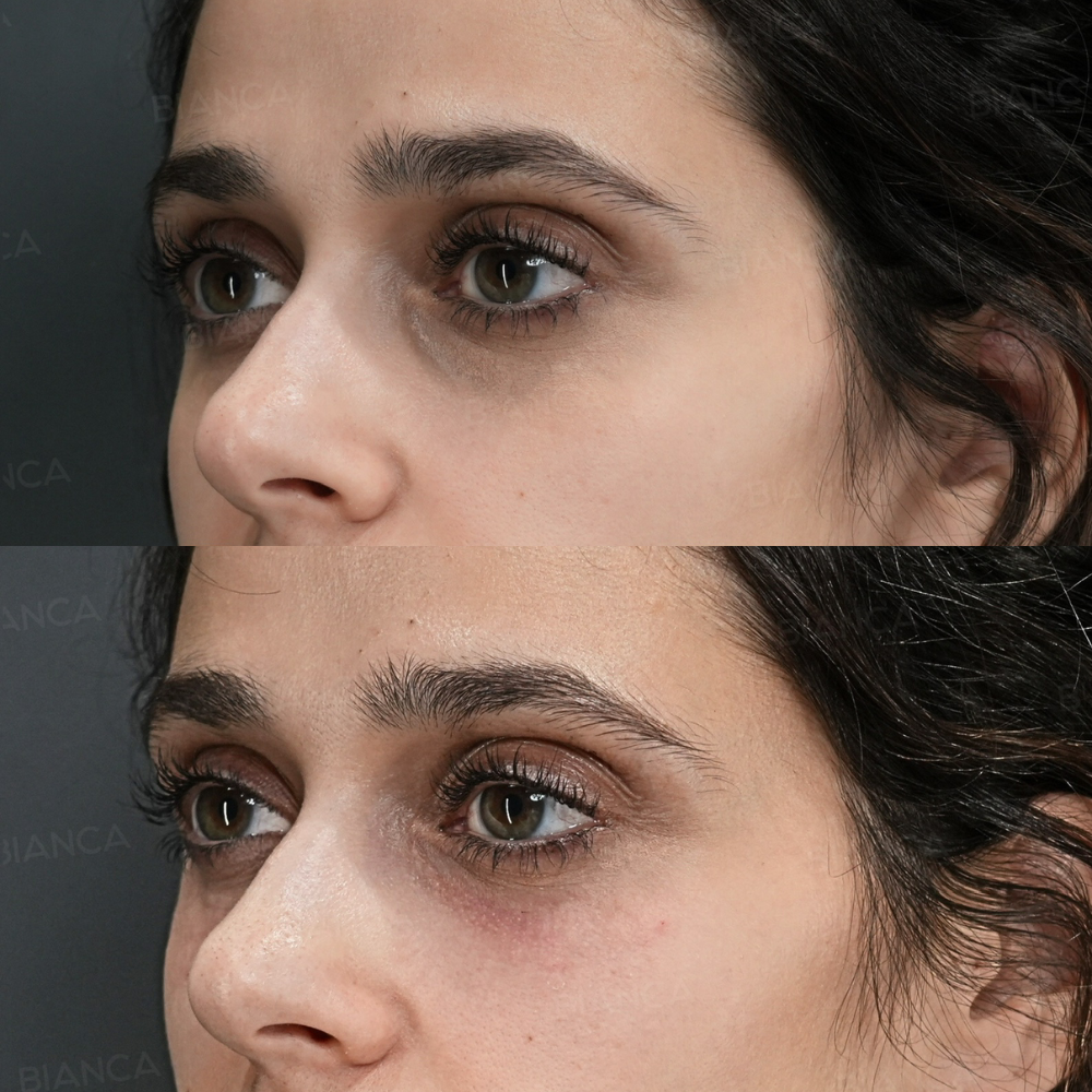 ベビーコラーゲン(目の下)