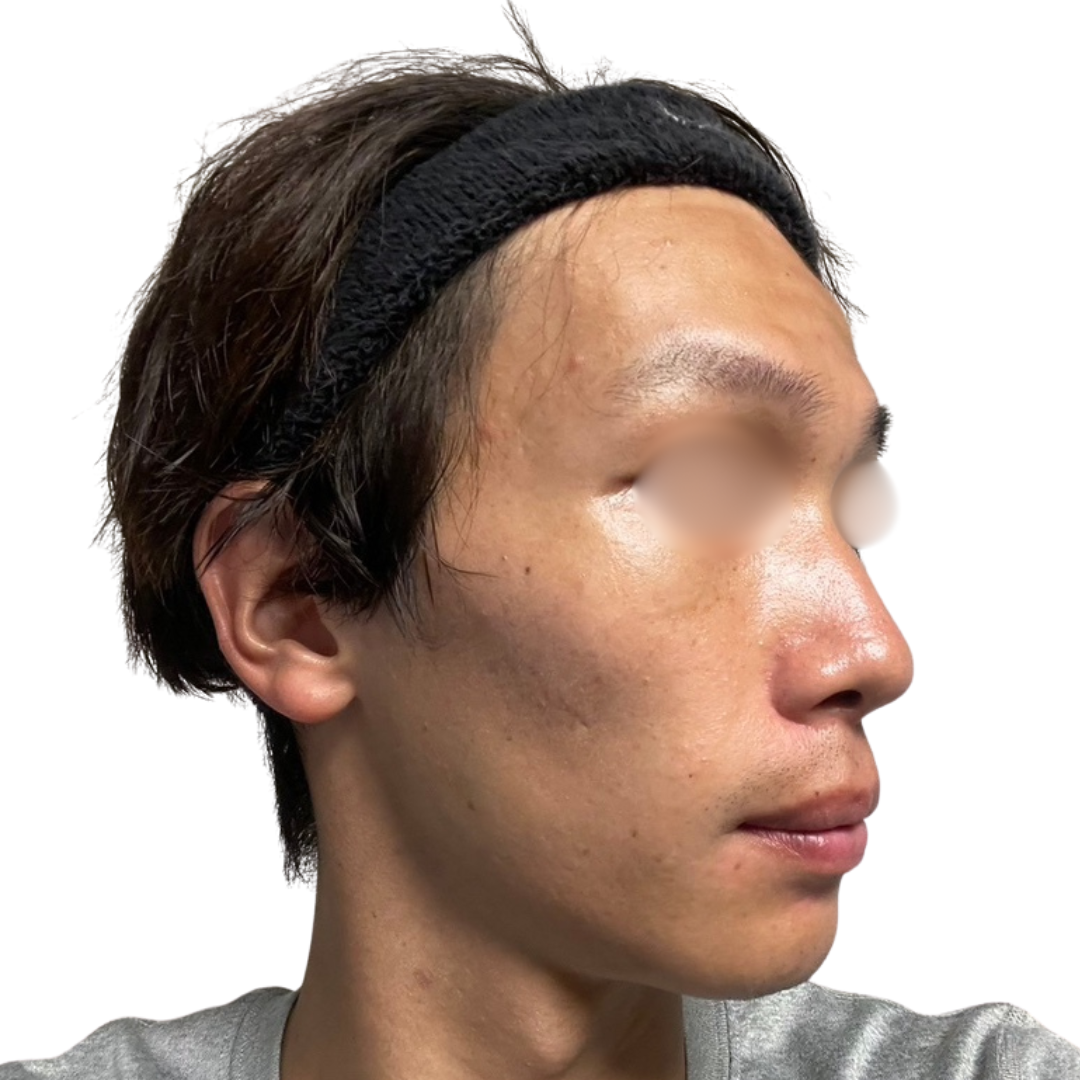 トライフィルプロ