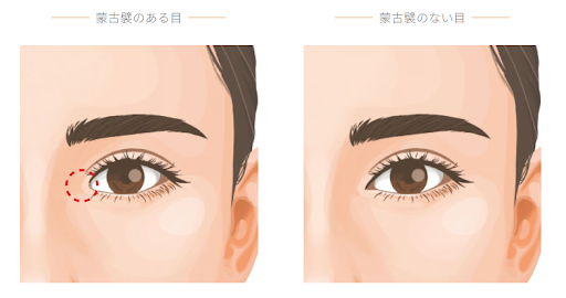 蒙古襞形成（目頭切開修正）とは