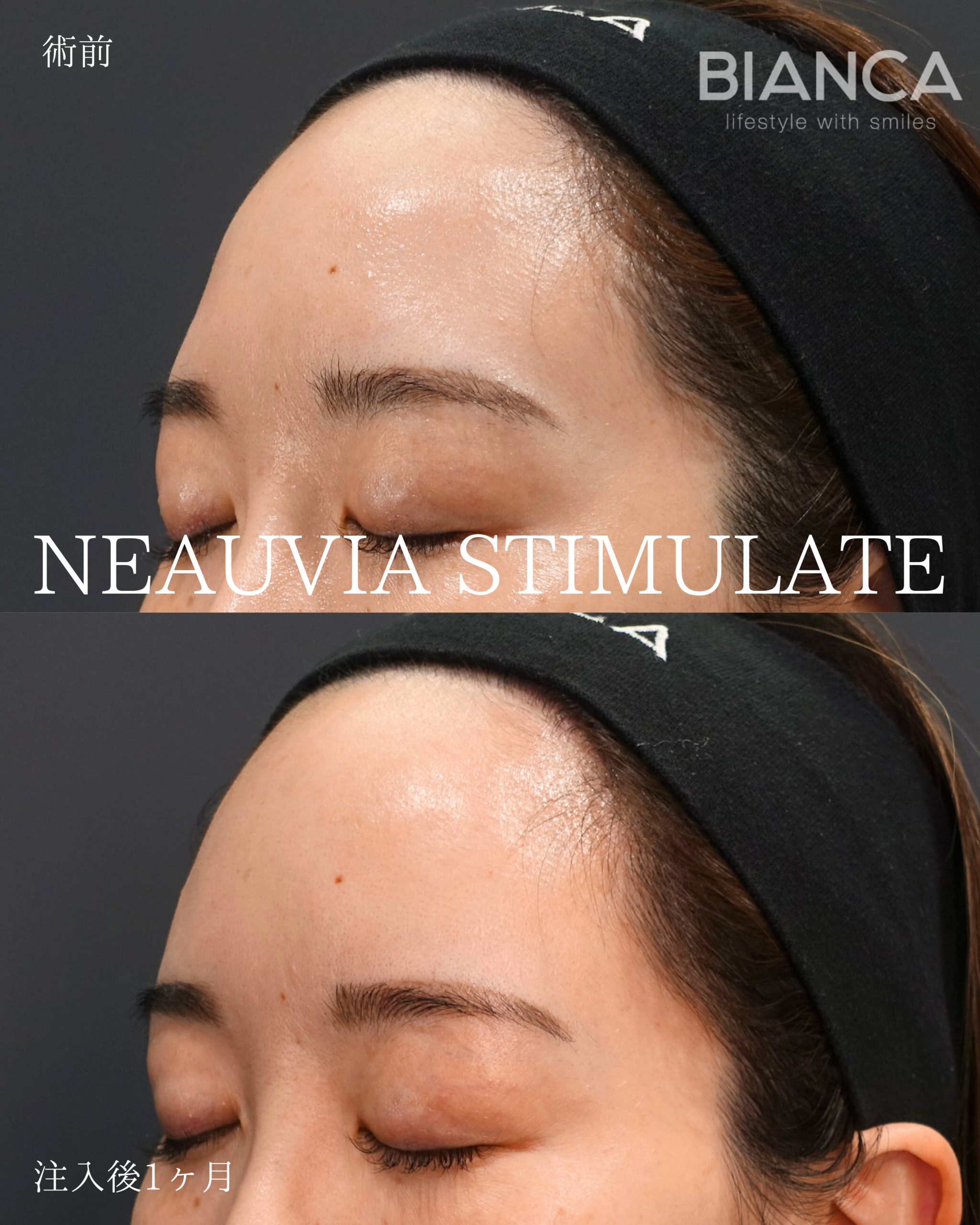 ヒアルロン酸注射