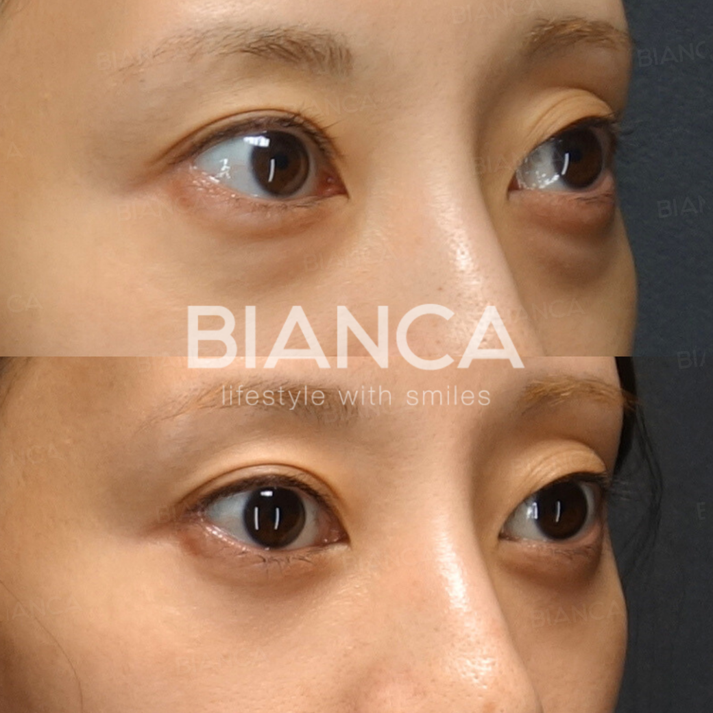 目の下クマ・たるみ取り（経結膜脱脂術）	