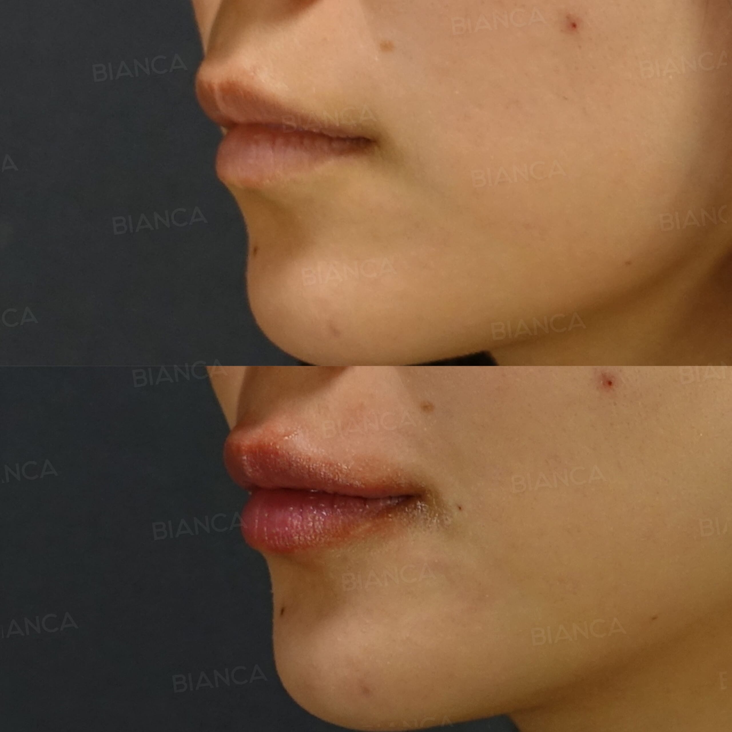 ヒアルロン酸注射(唇)