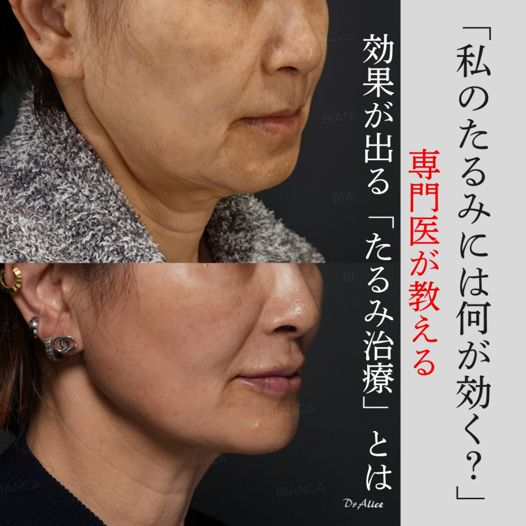 顔のたるみ、何を選べば正解？ 切る治療・切らない治療を本音で全部解説