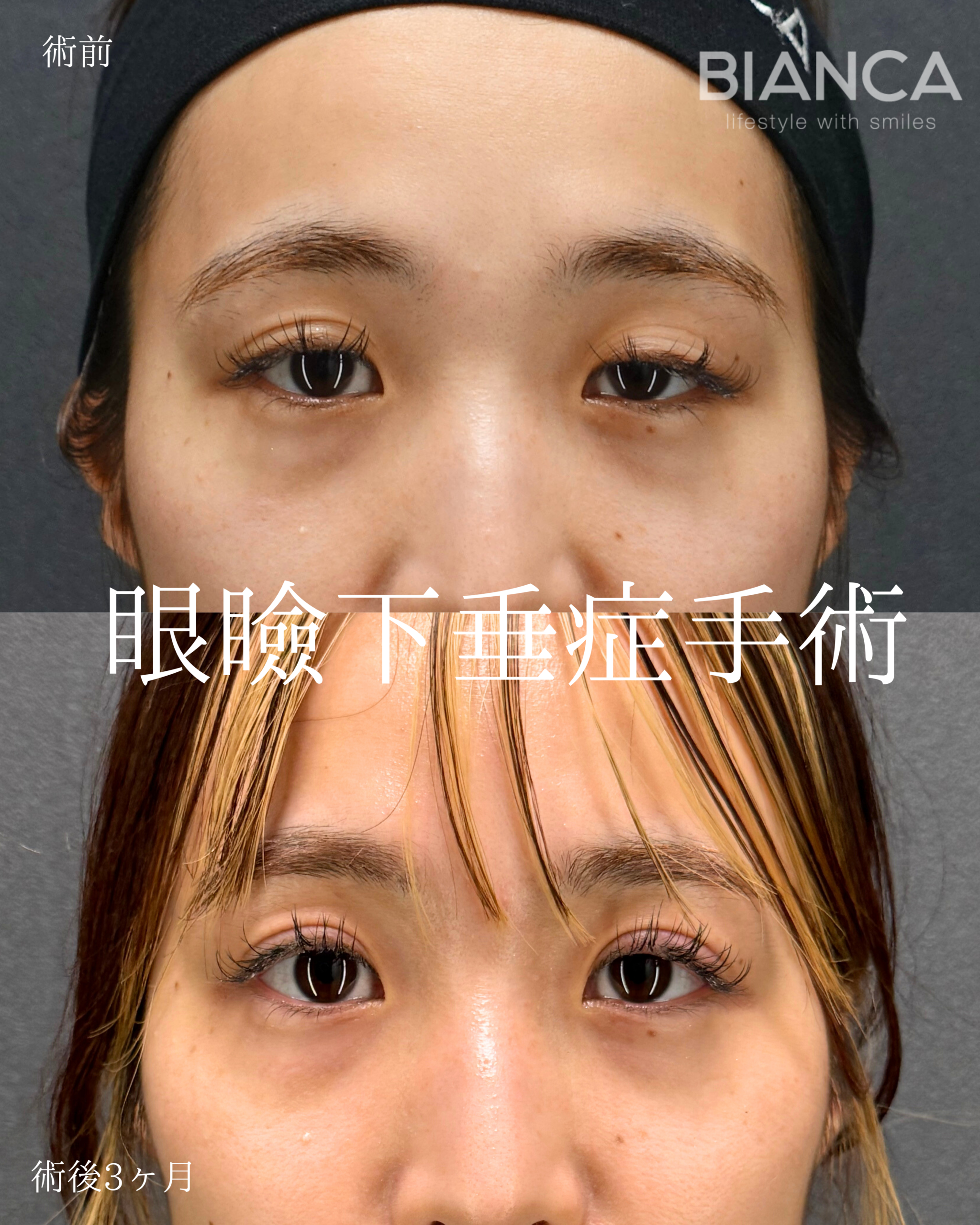 眼瞼下垂切開法