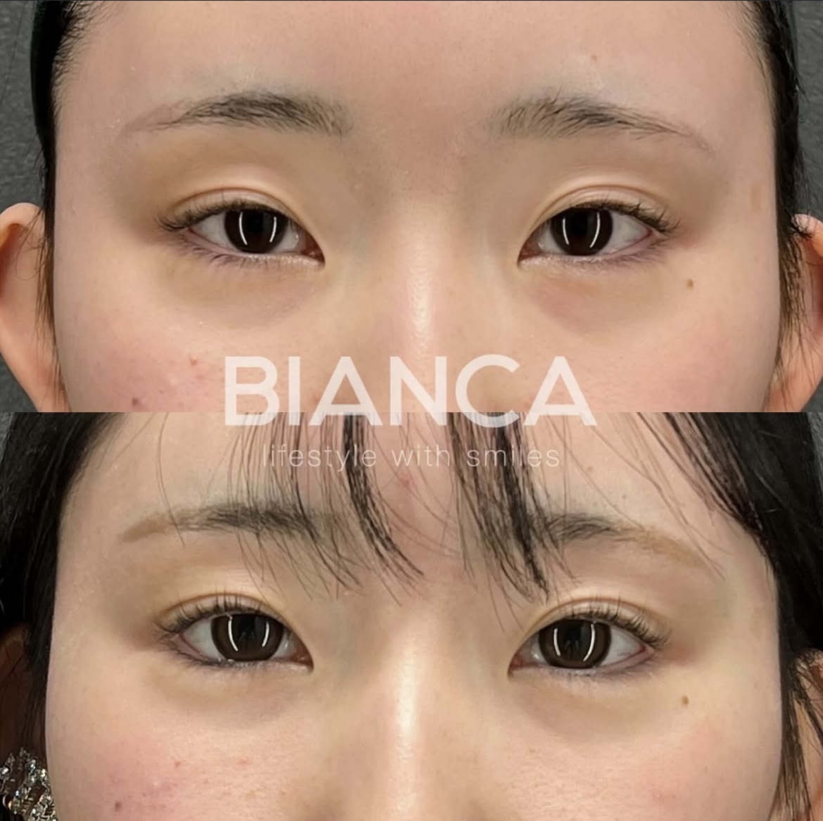 グラマラスライン形成（タレ目形成）