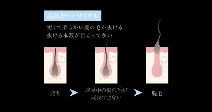 女性男性型脱毛症（FAGA）の特徴とメカニズム