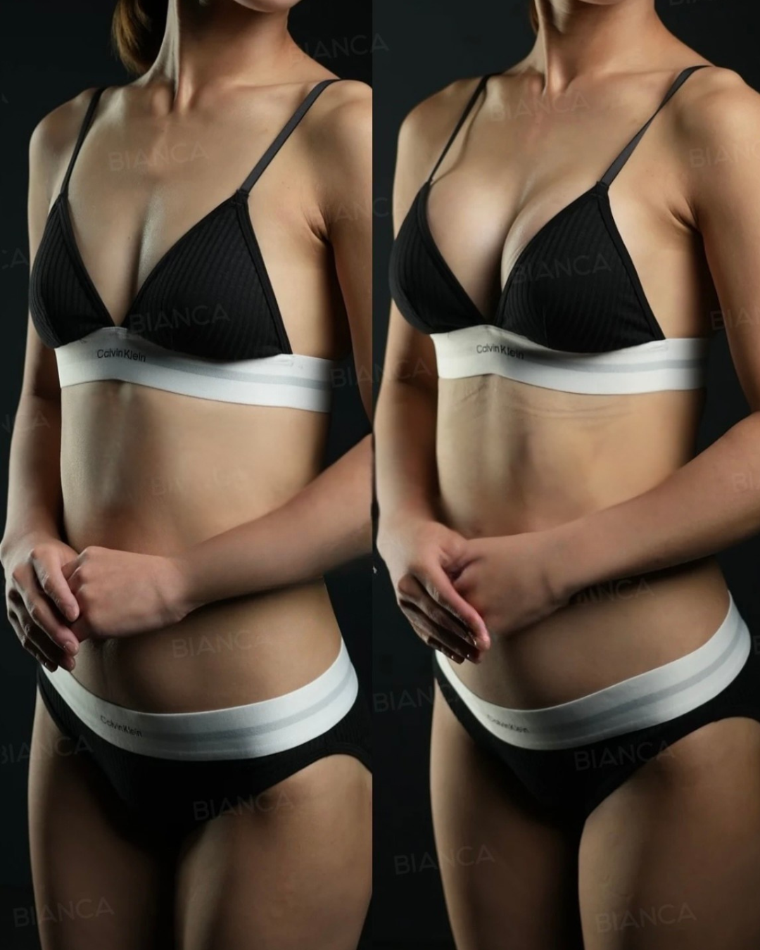 シリコンバック豊胸(preserve)