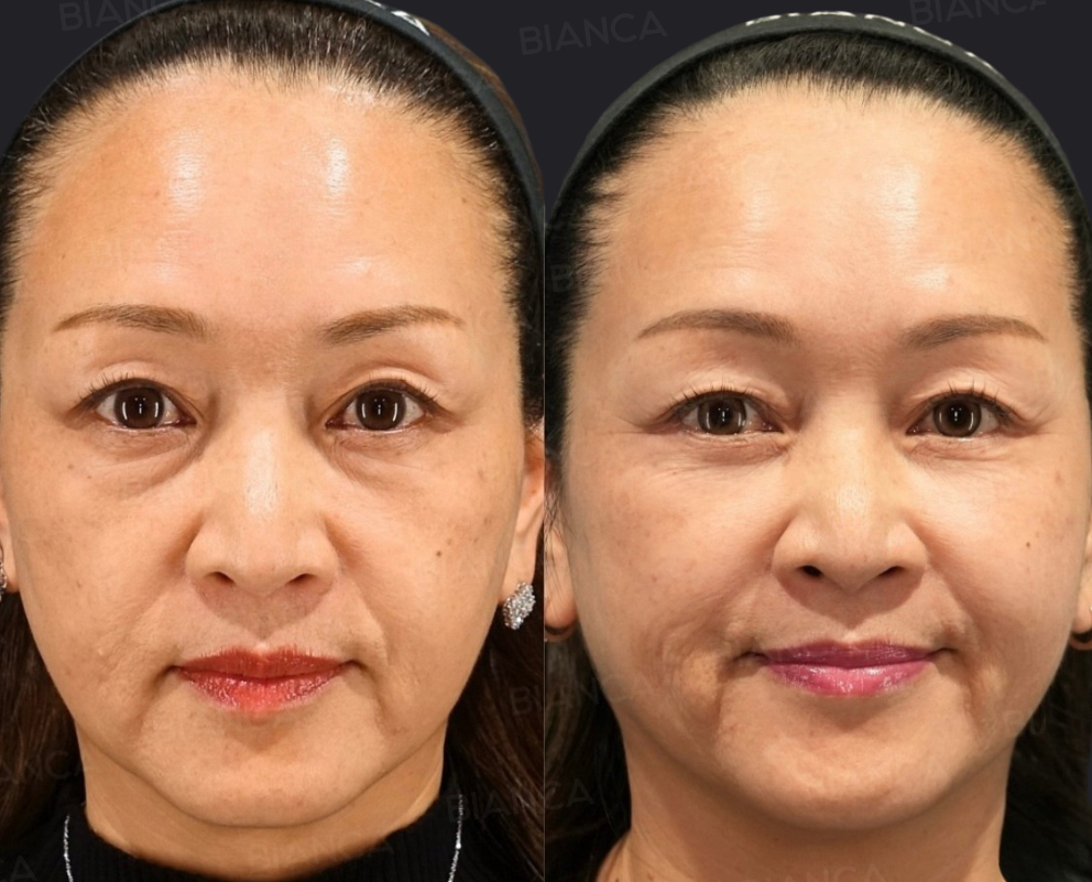 ミッドフェイスリフト（骨膜下）