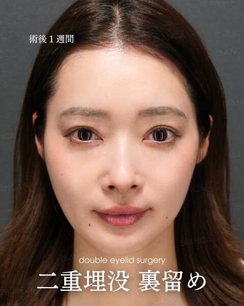 二重埋没 裏留め 銀座・表参道にあるBIANCA CLINIC ビアンカクリニック|美容外科・美容皮膚科・再生医療・美容婦人科・美容内科