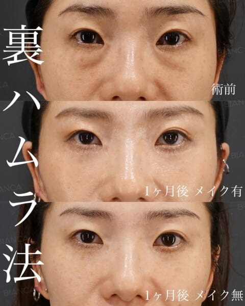 裏ハムラ法 銀座・表参道にあるBIANCA CLINIC ビアンカクリニック｜美容外科・美容皮膚科・再生医療・美容婦人科・美容内科