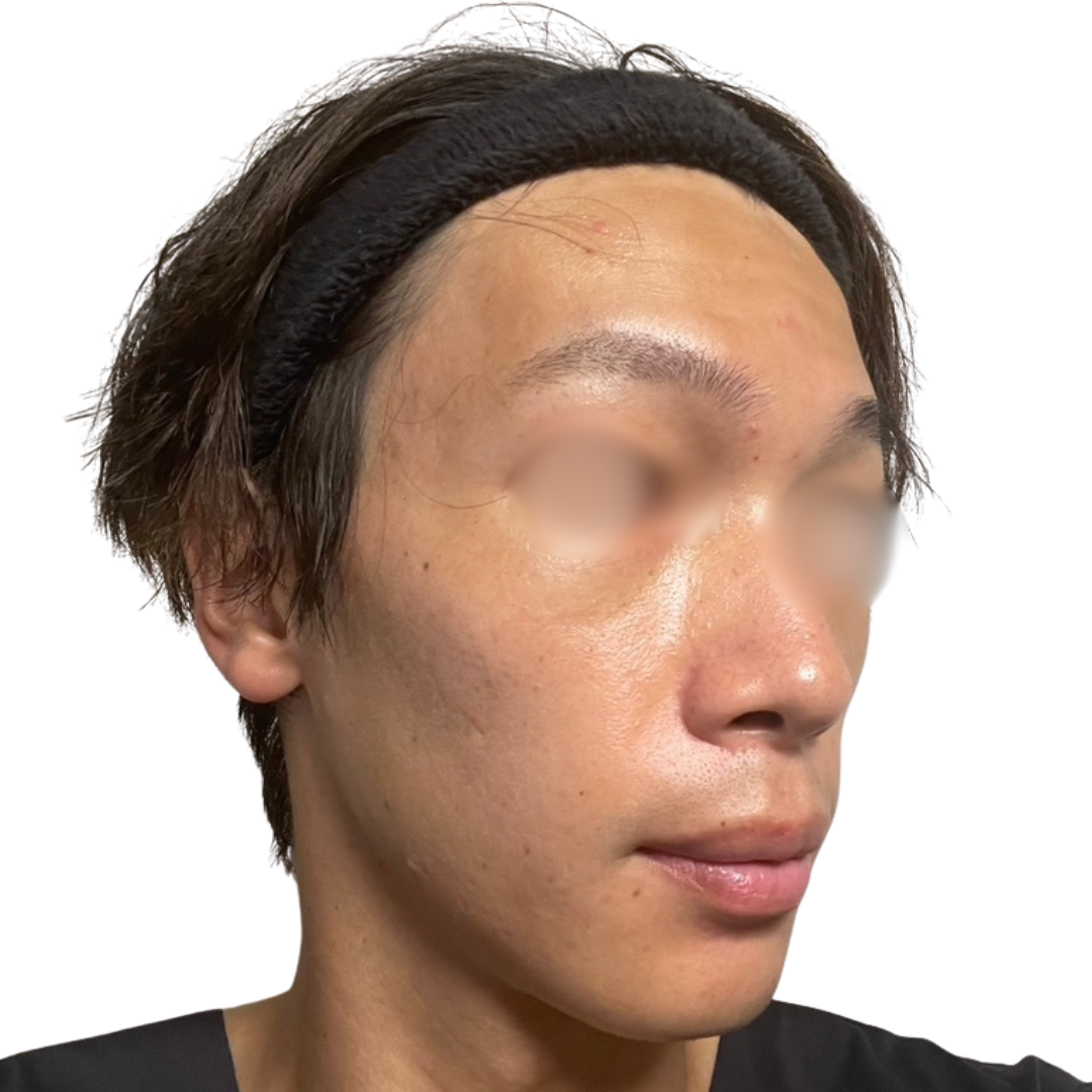 トライフィルプロ