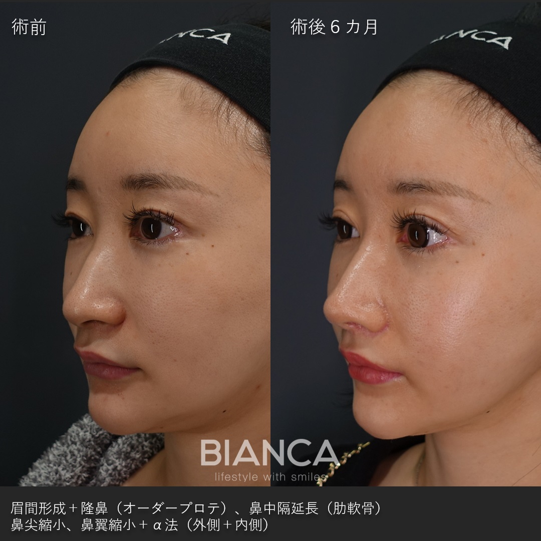 隆鼻術・鼻中隔延長・鼻翼縮小