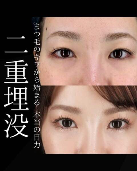 二重埋没 銀座・表参道にあるBIANCA CLINIC ビアンカクリニック|美容外科・美容皮膚科・再生医療・美容婦人科・美容内科