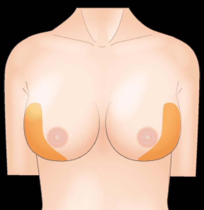  下垂や左右差といった形状のお悩みも解消