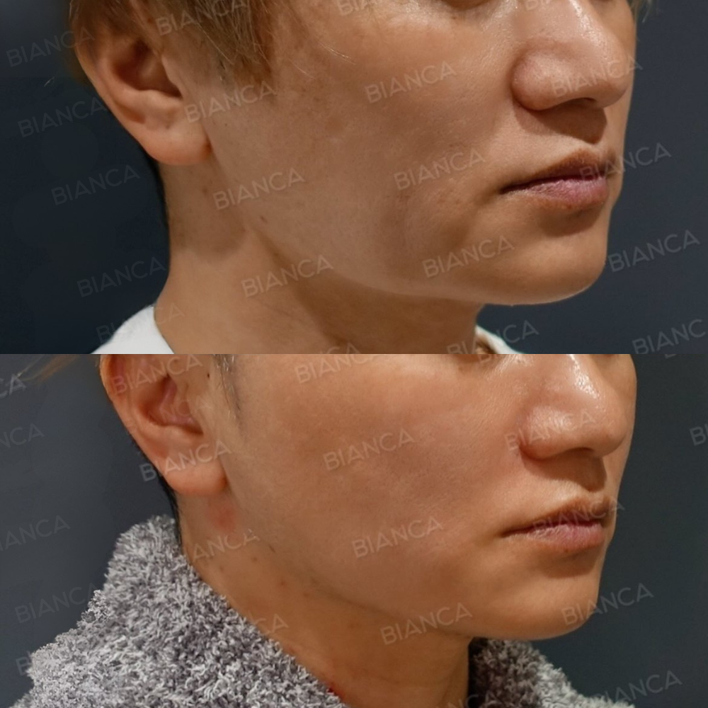 BIANCA LIFT ヒアルロン酸(鼻翼基部）