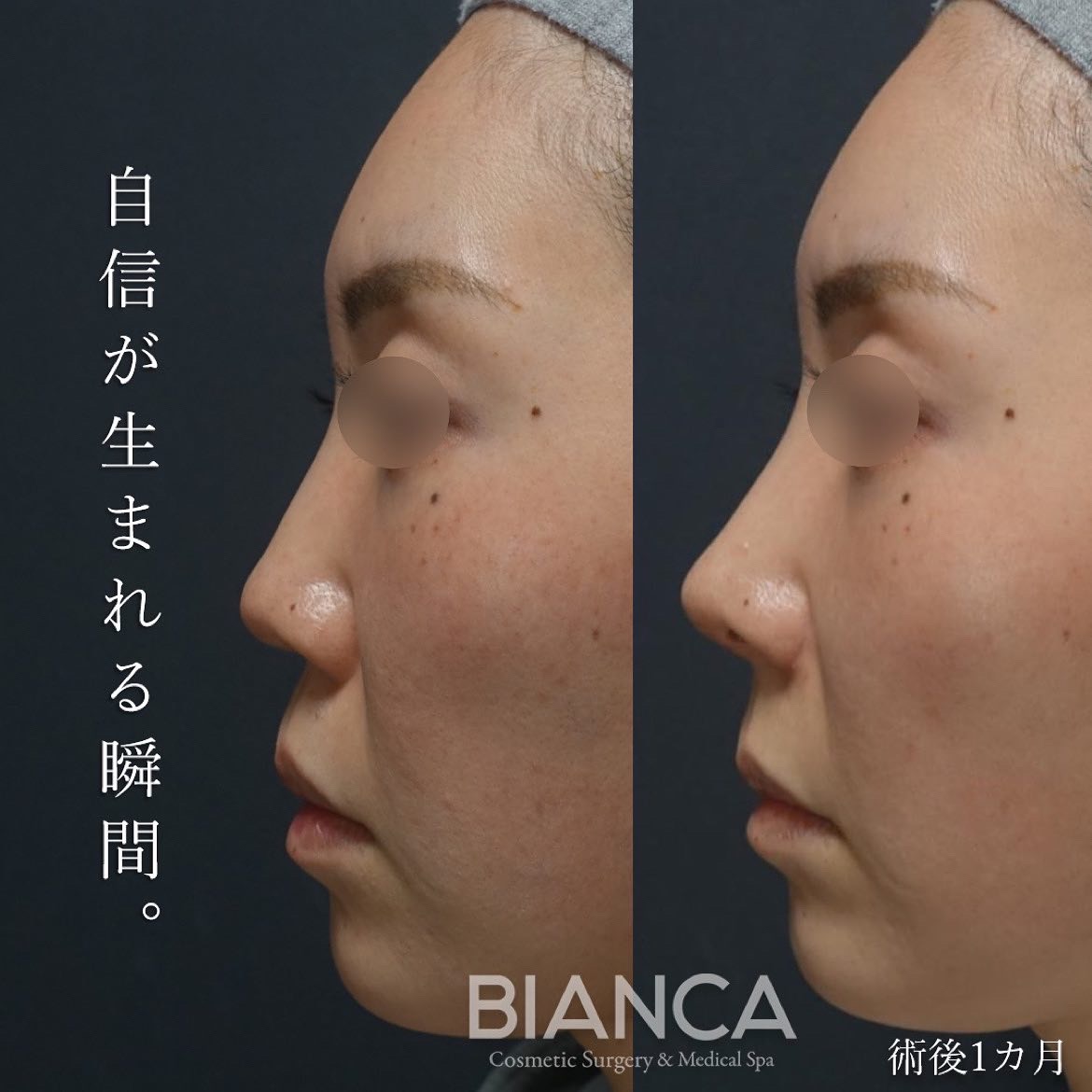 隆鼻術・鼻中隔延長・貴族手術・鼻翼縮小 