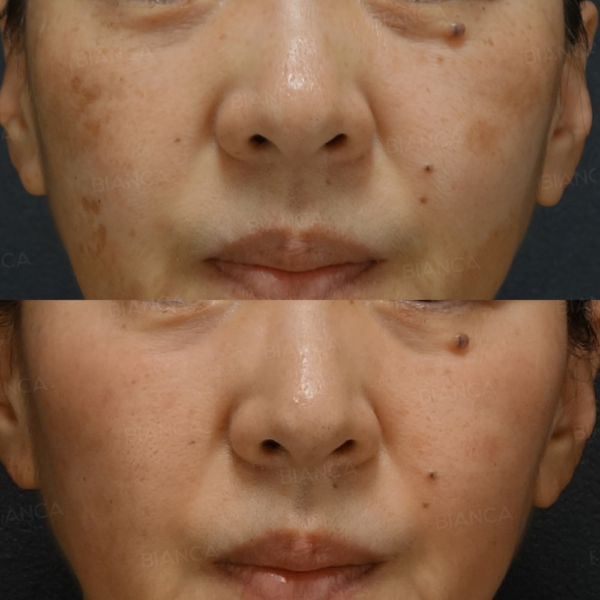 ピコスポット｜銀座・表参道にあるBIANCA CLINIC ビアンカクリニック｜美容外科・美容皮膚科・再生医療・美容婦人科・美容内科・医療アートメイク