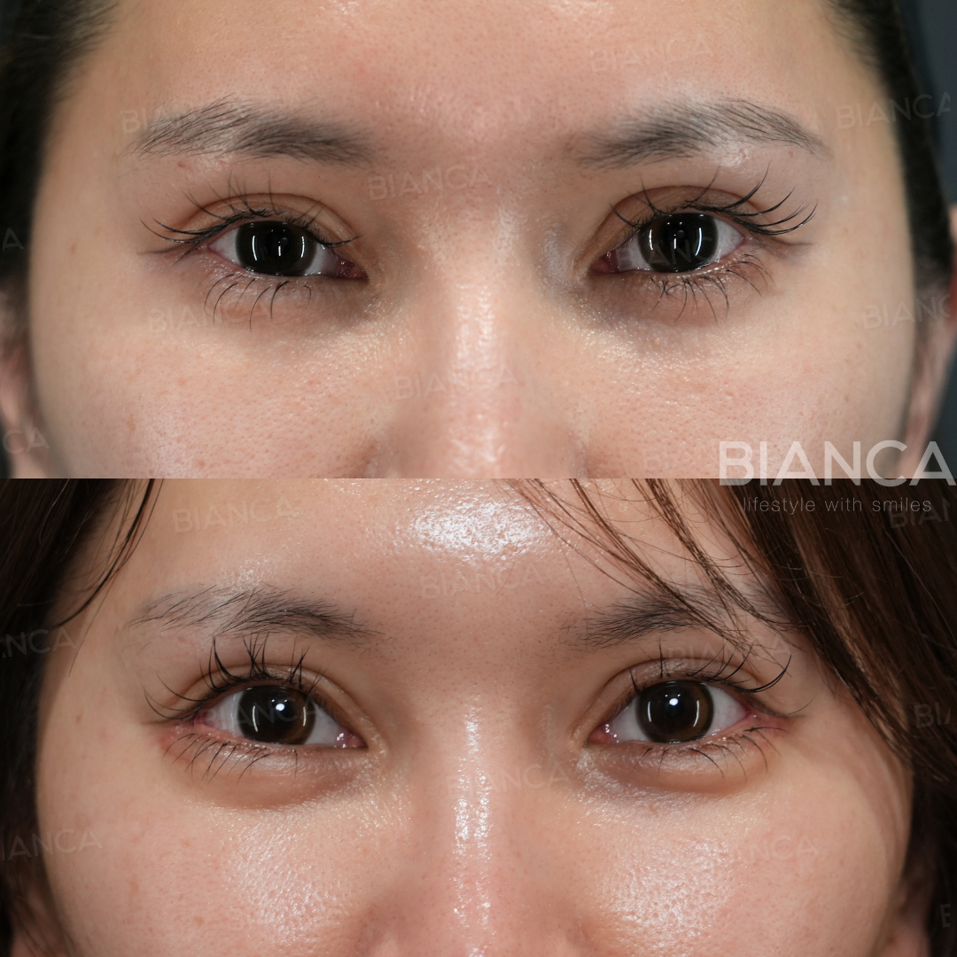 グラマラスライン形成（下瞼開大術）