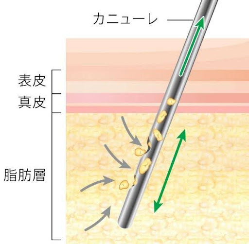 ベイザー（VASER®）フェイスライン脂肪吸引とは