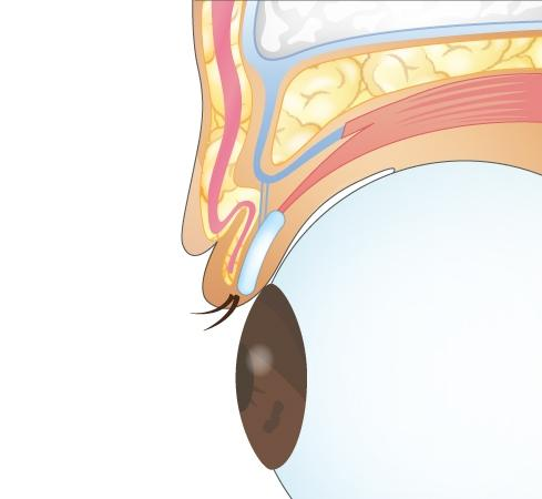 二重埋没法のアプローチ方法は2種類