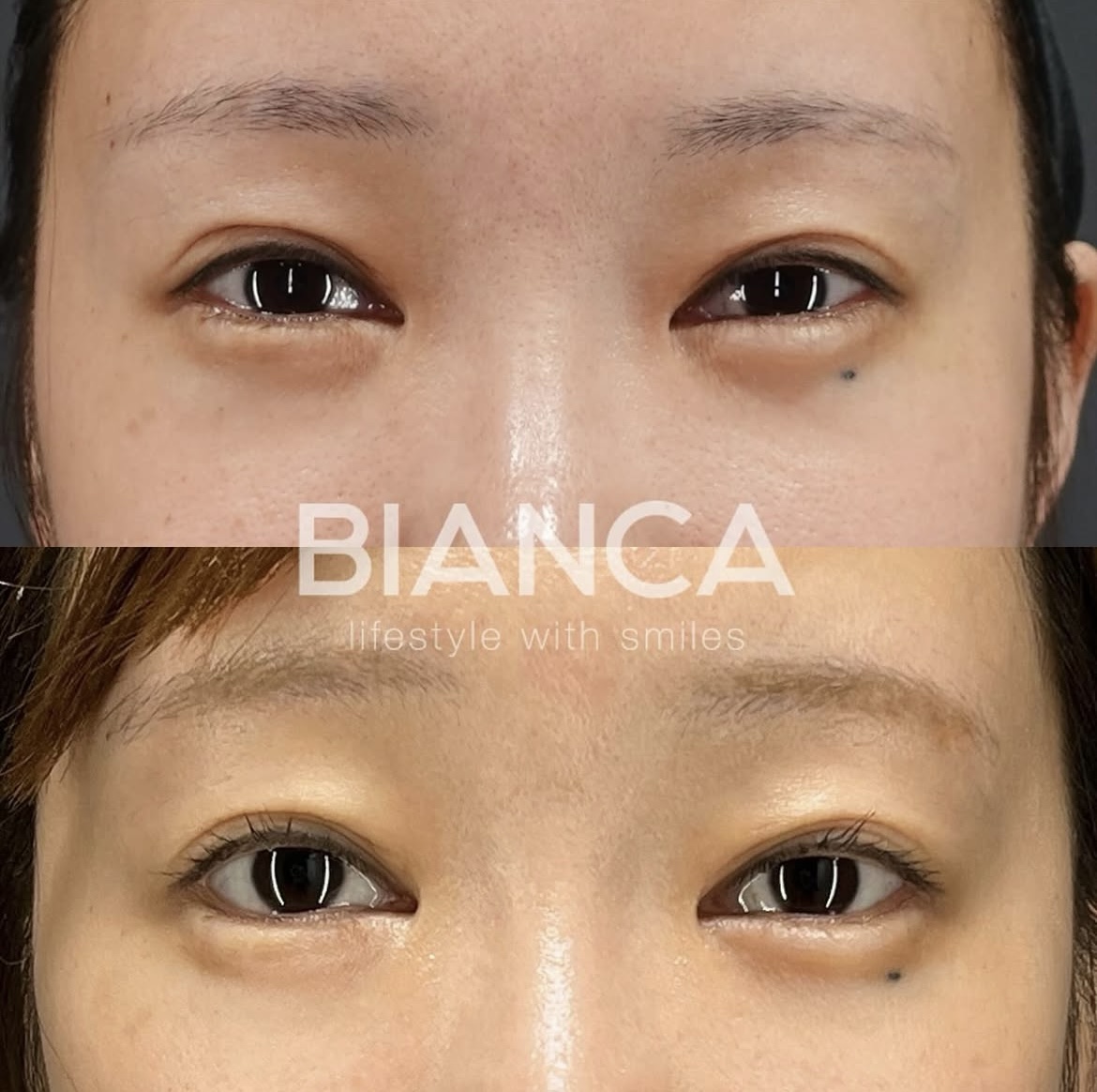 グラマラスライン形成（タレ目形成）