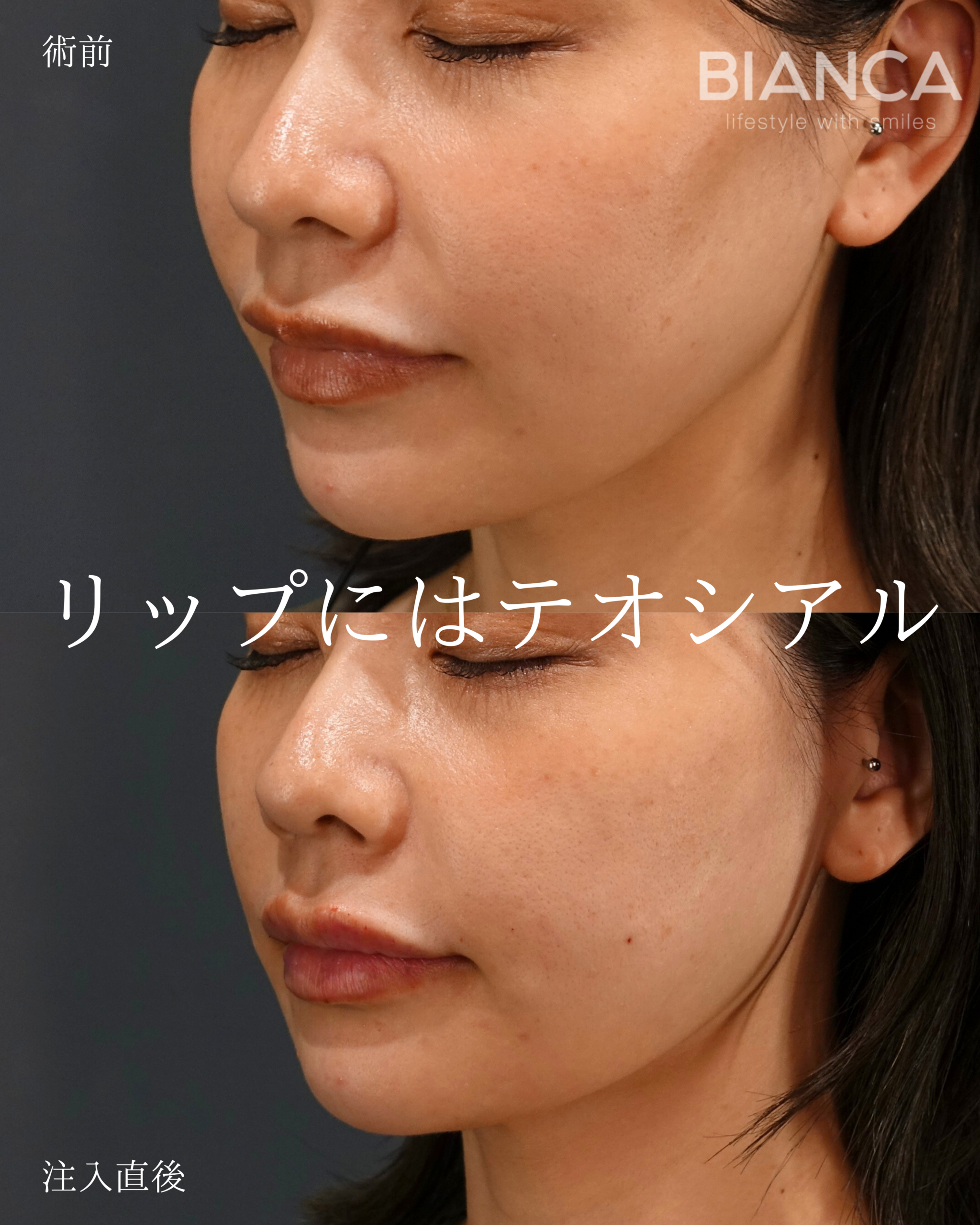 ヒアルロン酸注射