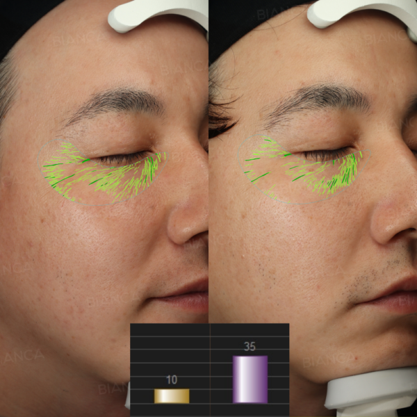 ナノステム(顔)｜銀座・表参道にあるBIANCA CLINIC ビアンカクリニック｜美容外科・美容皮膚科・再生医療・美容婦人科・美容内科・医療アートメイク