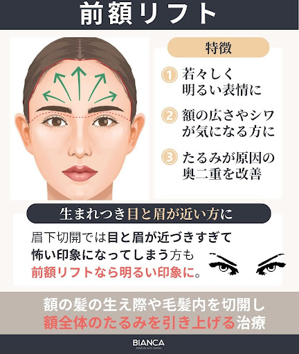 前額リフトとは