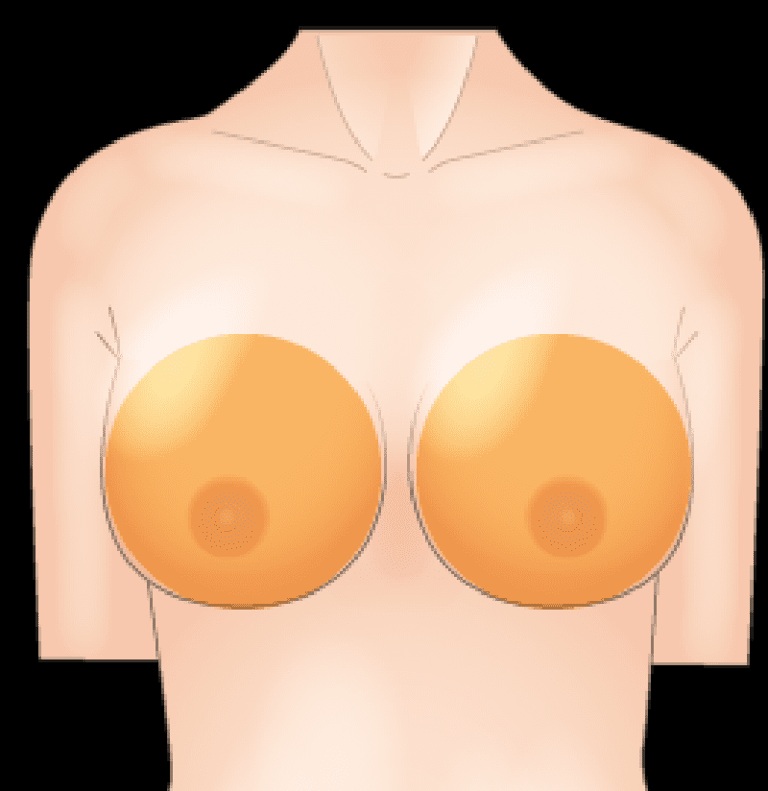  下垂や左右差といった形状のお悩みも解消
