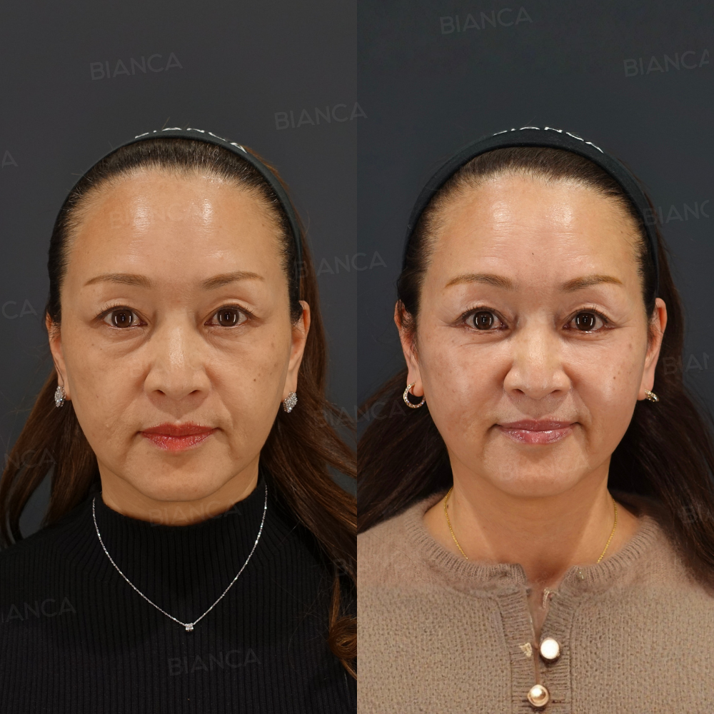 ミッドフェイスリフト（骨膜下）