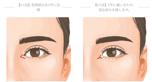 一人ひとりの目元に合った術式を選択