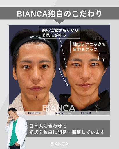 ネックリフトとの組み合わせにより若々しいフェイスラインを形成