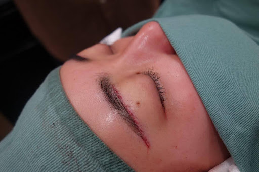 眉下リフト+ROOF切除とは