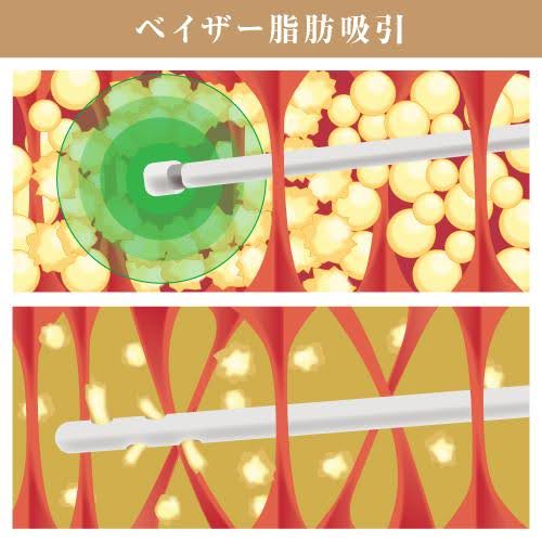 ベイザー脂肪吸引と従来の脂肪吸引の違い
