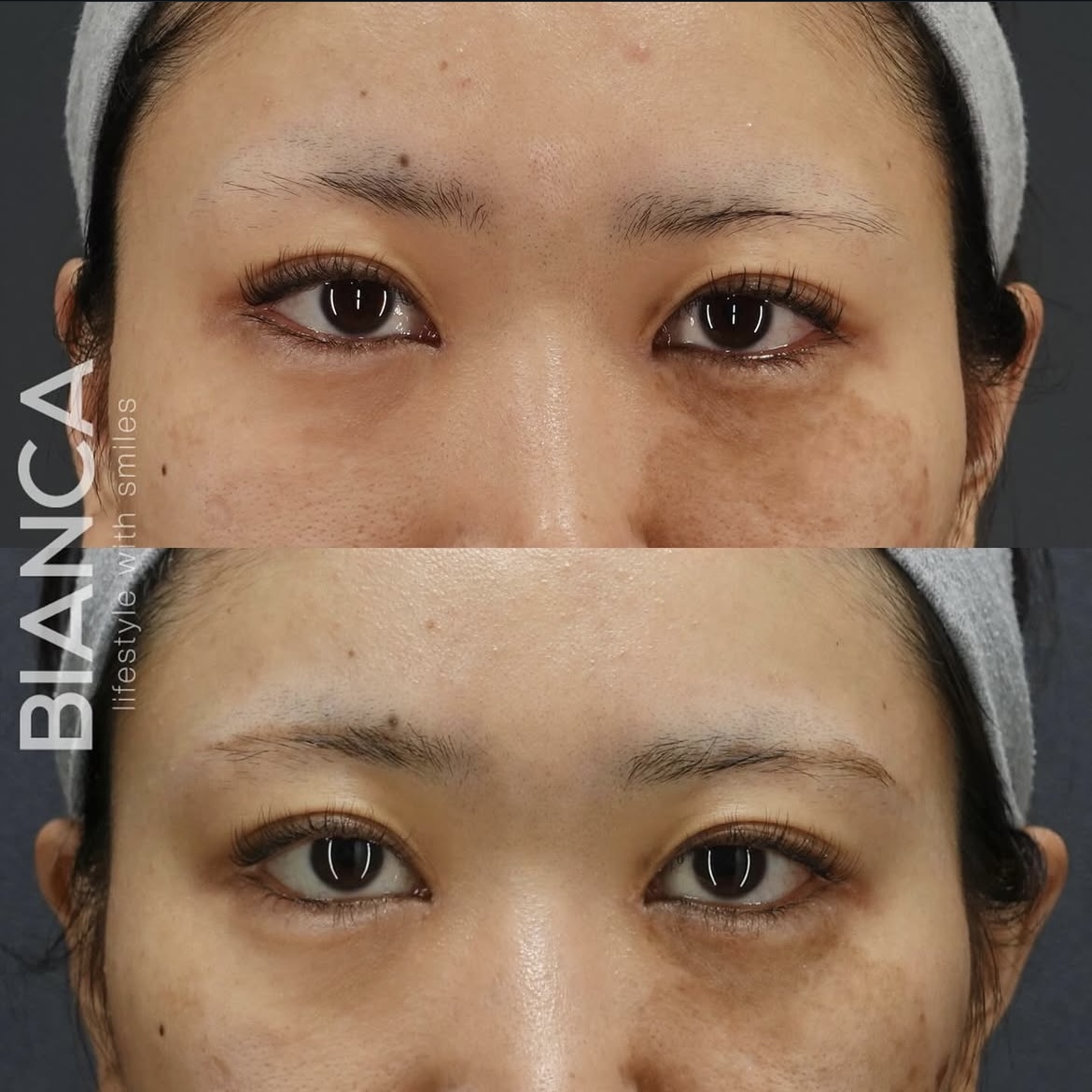 グラマラスライン形成（タレ目形成）