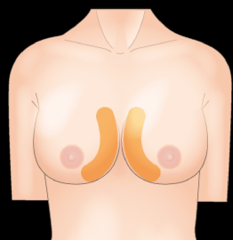  下垂や左右差といった形状のお悩みも解消