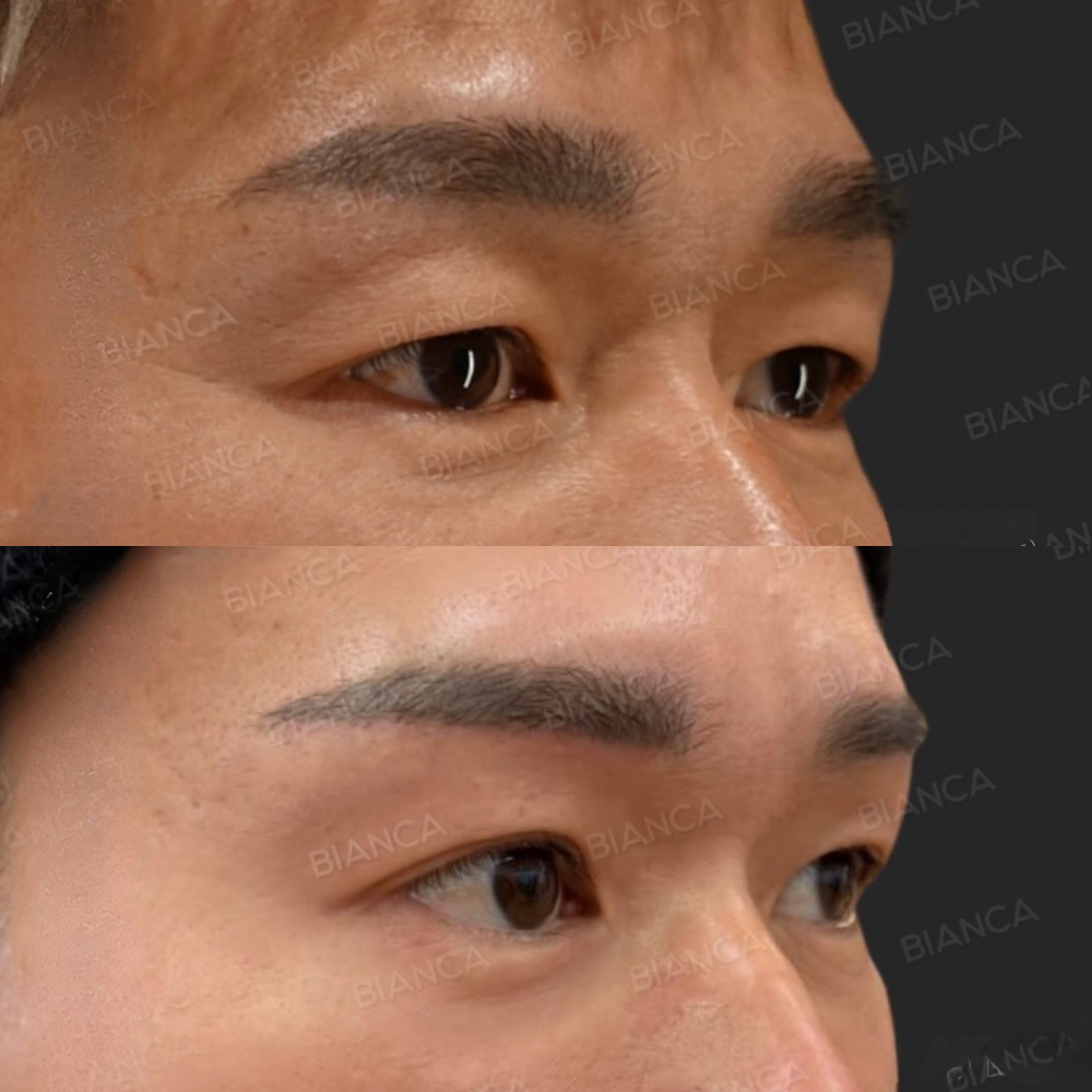 眉下リフト（眉下切開）