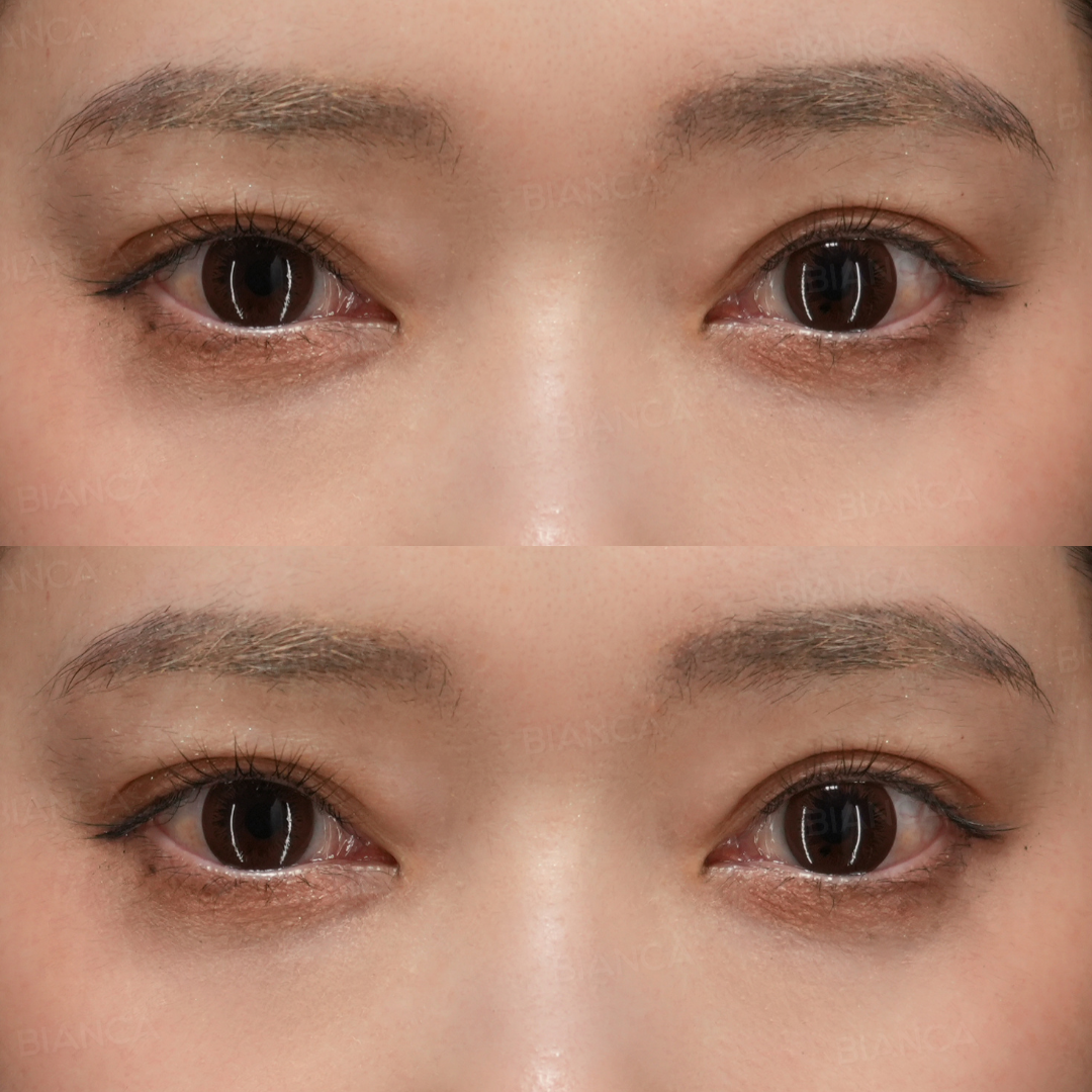 二重埋没（B TWICE）