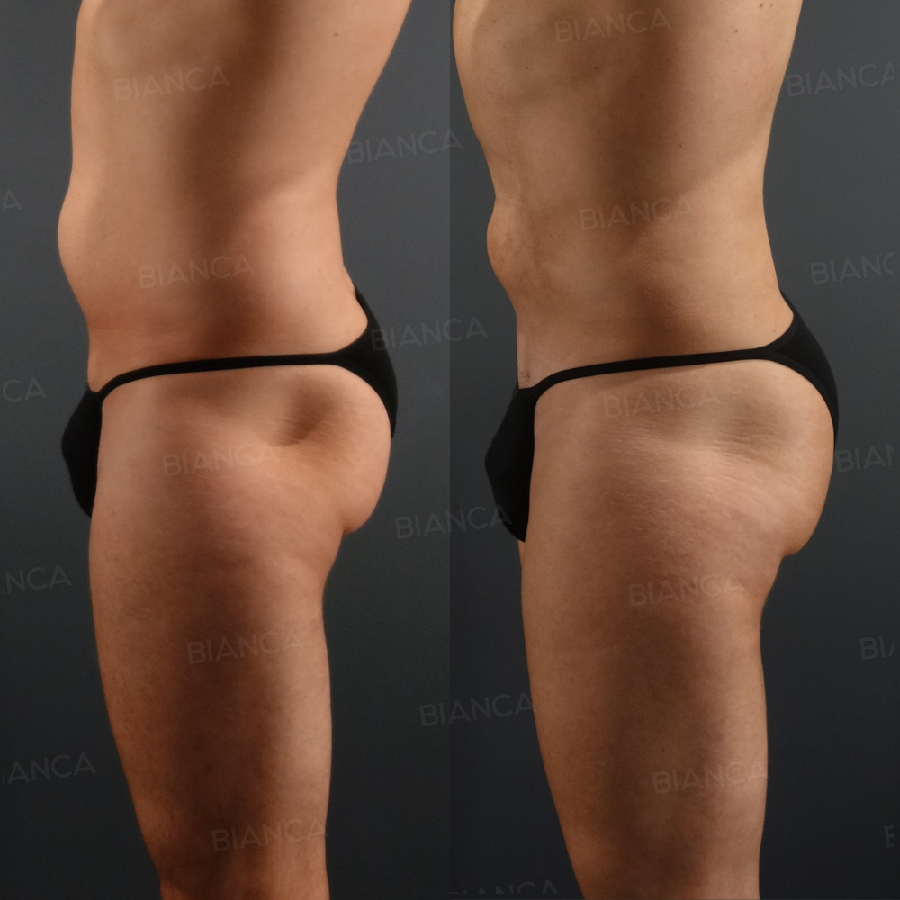 アブクラックス形成、ベイザー脂肪吸引ボディ、豊尻(ブラジリアンバットリフト)