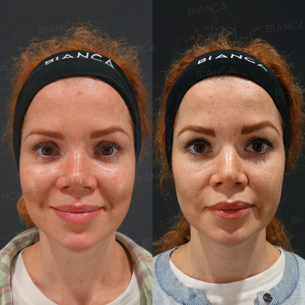 ピコスポット 顔全体