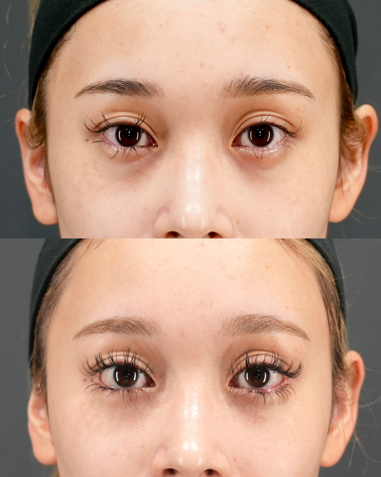 タレ目尻切開 ・グラマラスライン形成