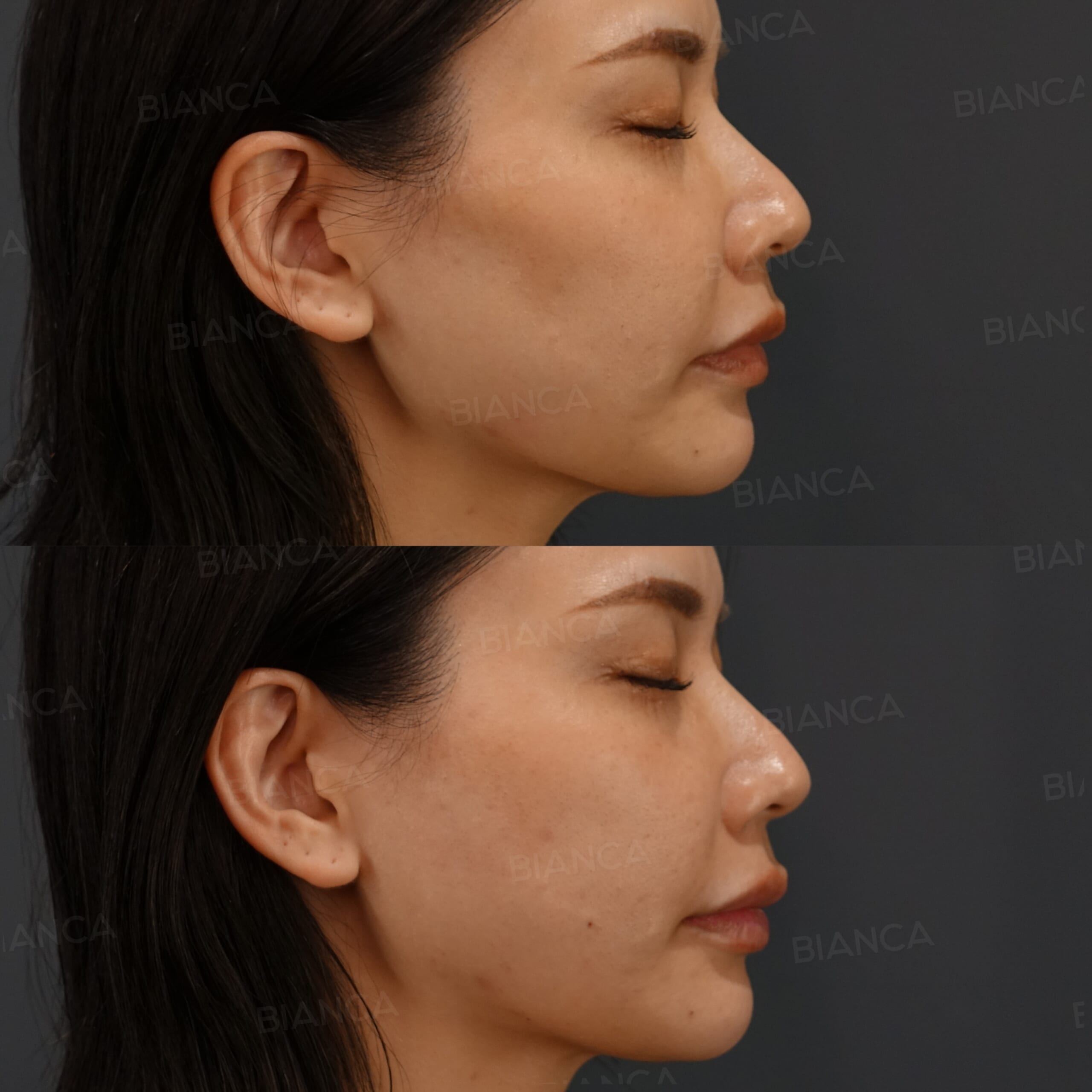 ヒアルロン酸注射（頬コケ・口唇）