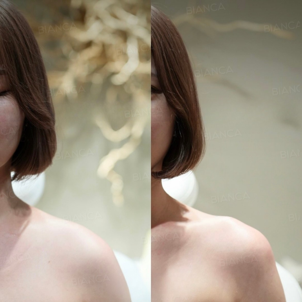 ヒアルロン酸注射（肩・鎖骨）