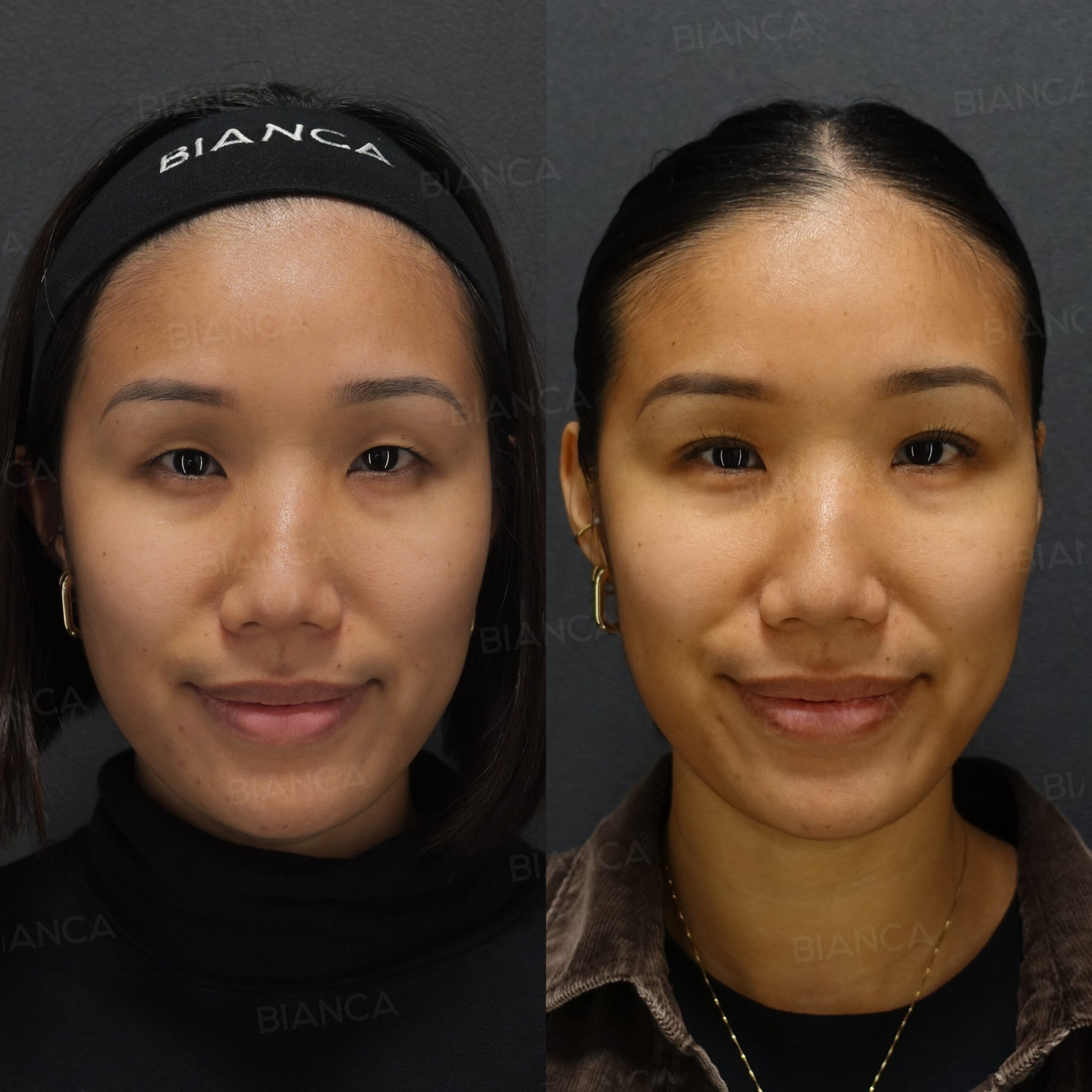 二重埋没法（裏留め）B TWICE